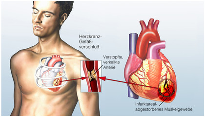 Angina Pectoris. Herzinfarkt