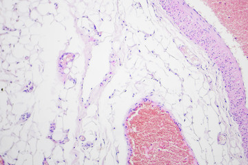 Colon cancer microscopic photography, magnification x100