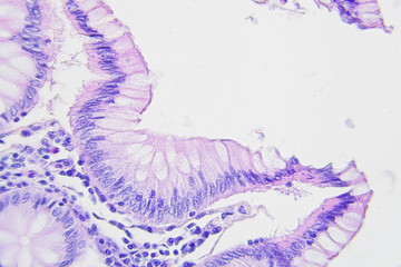 Colon cancer microscopic photography, magnification x400