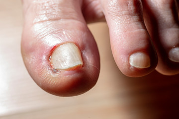 nail disease