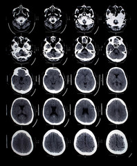 Head x-ray film images used to diagnose neurological and tumor diseases for diagnosis. X-ray film images taken from the x-ray room for diagnosis of faults that require surgery for medical treatment.