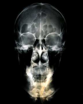 Head x-ray film images used to diagnose neurological and tumor diseases for diagnosis. X-ray film images taken from the x-ray room for diagnosis of faults that require surgery for medical treatment.