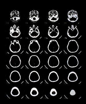 Head x-ray film images used to diagnose neurological and tumor diseases for diagnosis. X-ray film images taken from the x-ray room for diagnosis of faults that require surgery for medical treatment.