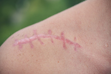 Scarring. Scar on the shoulder after injury. Mark on the body. Operational stitch. Scar Cream. Surgery, medicine.