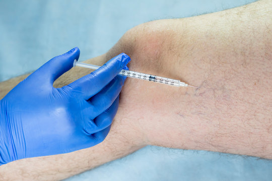 Doctor Examines A Man S Leg. There Is Varicose Veins