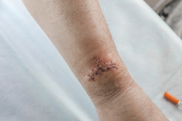 a doctor in blue gloves examines a wound on his leg. there is a cut and sewn with threads.