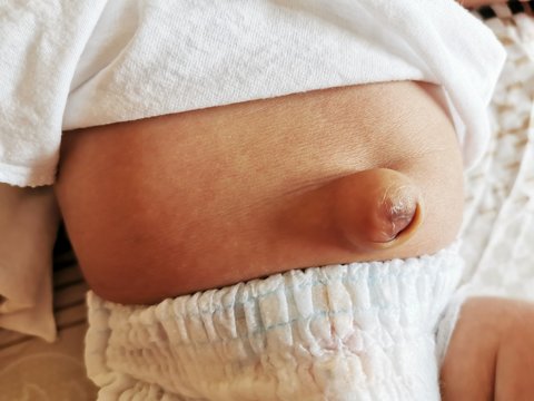 Large umbilical hernia in premature newborn baby Stock Photo