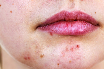 Female face with acne skin problem