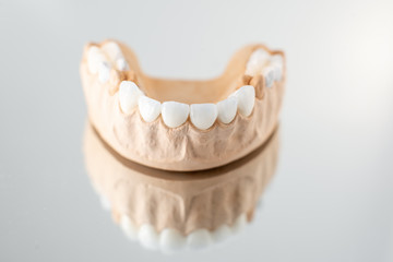 Close-up on plaster model of artificial jaw with veneers on the mirror background. Concept of aesthetic dentistry and design of veneers
