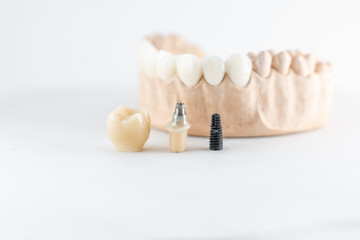 Close-up on plaster model of artificial jaw and dental implant on the white background. Concept of...