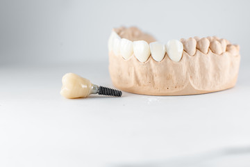 Fototapeta na wymiar Close-up on plaster model of artificial jaw and dental implant on the white background. Concept of prosthetics and implantation in dentistry