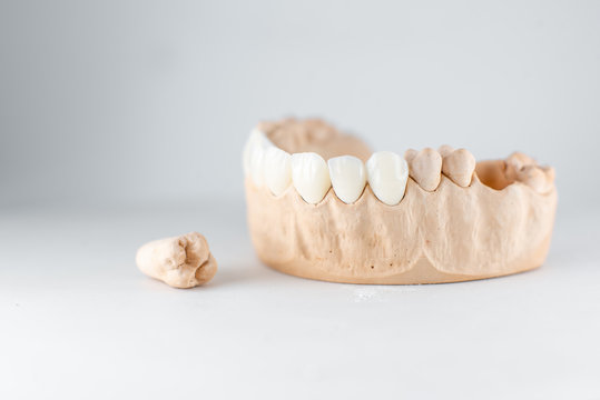 Close-up on plaster model of artificial jaw with veneers and tooth on the white background. Concept of prosthetics and implantation in dentistry