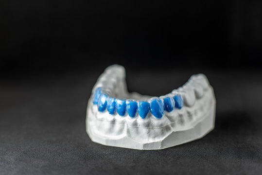 Close-up on plaster model of artificial jaw with teeth painted in blue and transparent cap on the black background