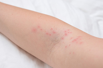 Skin rash on female arm, itchy pimples as a result of an allergic reaction, response, concept of allergy and dermatology