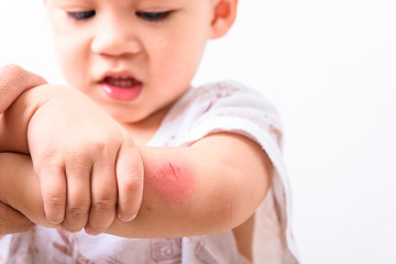Asian boy kid show arm accident wound he painful abrasion scratches from fall