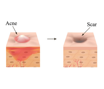 Inflamed acne on the skin. Inflamed pimple. The structure of the skin. Acne scar. Infographics. Vector illustration on isolated background.