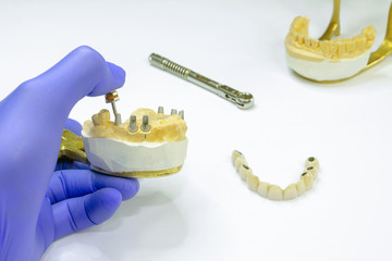 prosthetics on dental implants. concept of orthopedic dentistry. ceramic bridge on implants. dentist's hand holds a plaster jaw with dental abutments