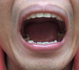 The man is opening his mouth that shows the teeth are extracted and filled and may cause the dental problems.