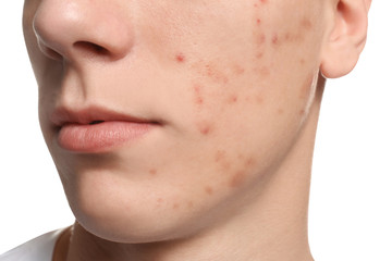 Teen guy with acne problem on white background, closeup