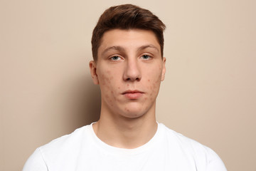 Obraz premium Teen guy with acne problem on beige background