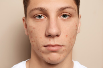 Teen guy with acne problem on beige background, closeup