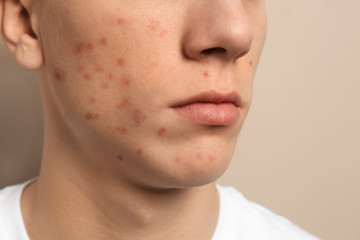 Teen guy with acne problem on beige background, closeup