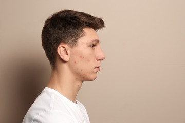 Obraz premium Teen guy with acne problem on beige background. Space for text