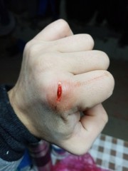 hand injury. skin damage and bleeding.