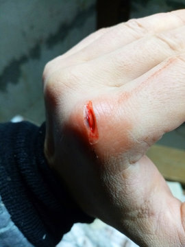 hand injury. skin damage and bleeding.