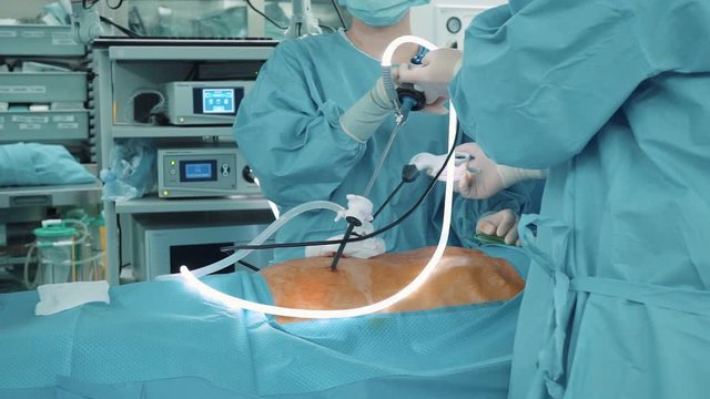Operation by laporoscopic method by several doctors
