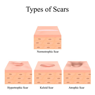 Types of scars. Acne scars. Keloid, hypertrophic, atrophic, normotrophic. The anatomical structure of the skin with acne. Vector illustration on isolated background.