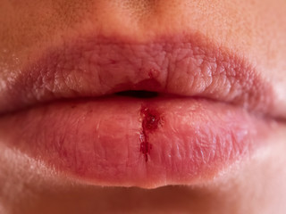 Close-up pale female lips cracked from frost, wind, lack of vitamins. Herpes disease virus wound....