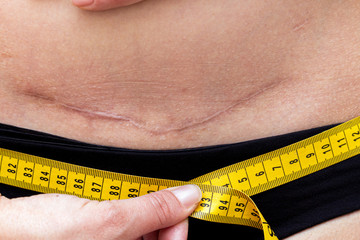 Woman with cesarean section postpartum scar measuring waist after childbirth. Body check. Diet...