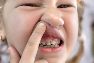 Adult permanent teeth coming in front of the child's baby teeth: shark teeth.