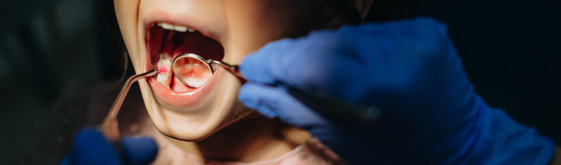 Close up of a girl mouth having a tooth examination by a pediatric stomatologist in pediatric dentistry.