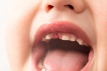 Fototapeta premium The mouth of a boy without a tooth