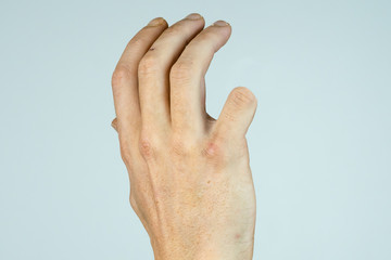 caucasian man hand with amputaded Little finger isolated on White background 