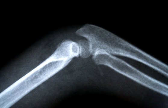 X-Ray image of human Bone joints