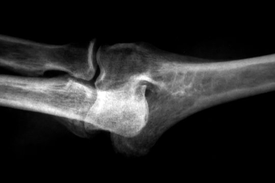 X-Ray image of human Bone joints