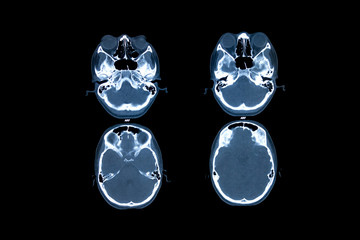 X-Ray image of human brain