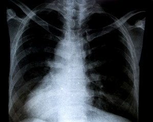 X-Ray Image Of Human Chest for a medical diagnosis