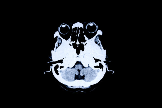 X-Ray image of human brain