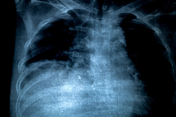 X-Ray Image Of Human Chest for a medical diagnosis