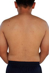 Fototapeta premium Man with acne with red spots on the back on white background.