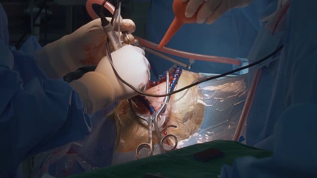 Surgeon performs surgery on human skull