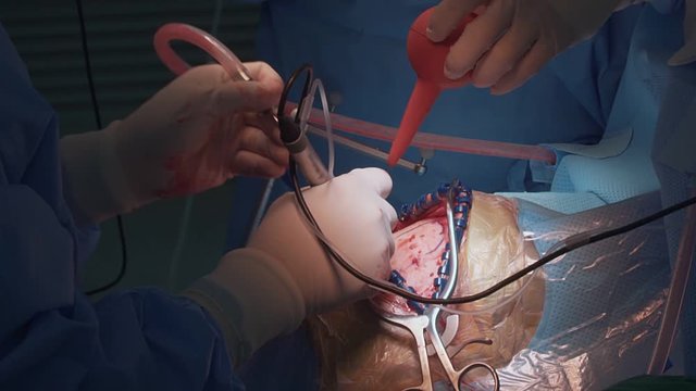 Surgeon performs surgery on human skull