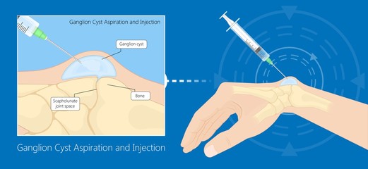 Ganglion cyst disease hand wrist trauma