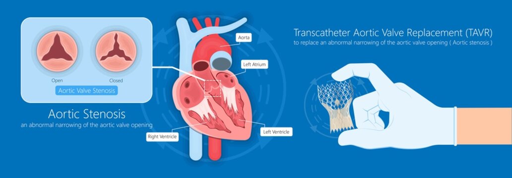 Transcatheter Aortic Valve Replacement (TAVR) Minimally Invasive Surgery