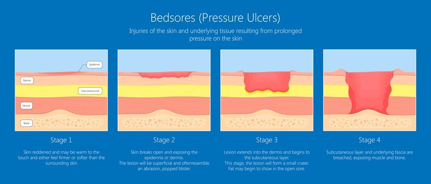 Bedsores (pressure ulcers) injuries skin underlying tissue from lying down or sitting prolonged period time with paralysis patient and immobility adults