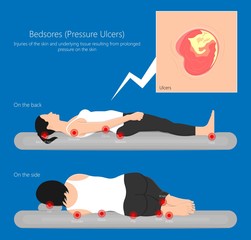 Bedsores (pressure ulcers) injuries skin underlying tissue from lying down or sitting prolonged period time with paralysis patient and immobility adults - obrazy, fototapety, plakaty